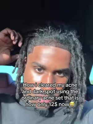 THE RESULTS SPEAK FOR ITSELF WATCH TO THE END THIS IS NOT CLICKBAIT THE ACNESET HEALED MY SKIN IN A WEEK #trending #foryoupagе #fyp #skincareroutine #skincare 
