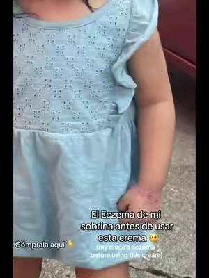 Les recomiendo esta crema le sano por completo la mano a mi sobrina, estuvimos batallando mucho para que le sanara por completo ya que ni las medicadas por su pediatra le servian #eczema #cream #eczemacream
#seamoss
#theoceanhealedmyeczema
#eczemaawareness #dryskin
#pielseca #ECZEMA #eczemaflareup
#eczemahealing #cremaparaeczema