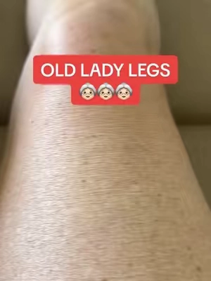 Old lady legs. #cellulite #womenover50 #antiagingskincare #strechmarks 