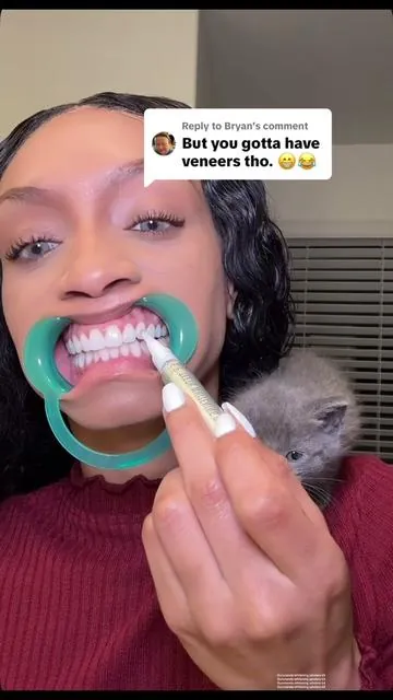 Replying to @Bryan  The new Gurunanda whitening wireless kit is the GOAT! You can see whiter teeth after just one use. It comes with hydrogen peroxide gel and a blue led light to activate and enhance the gels effectiveness. It also comes with whitening strips, a mouth retractor, a tongue scraper and oil pulling rinse to keep your teeth white. Love it! 💕 #gurunanda #teethwhitening #gurunandawirelesswhiteningnewarrival #gurunandasuperbrandday #whiteteeth #whiteningstrips @GuruNanda LLC @Puneet Nanda bridge the gap 