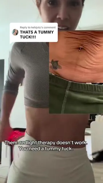 Replying to @kelsjuly best compliment! The before and after so 🤯 the internet thinks you got a tummy tuck!  Not surgical results. Just noninvasive, consistent use of redlight treatments at home with a firming cream.  (Tap cart to check out the secret to a mombod glow up)  #redlighttherapy #firming #looseskin #cellulitereduction #stretchmarks  #noninvasivebodycontouring #postpartumbody #momof5 #twinmoms 