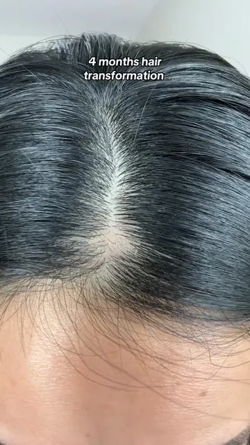My hair transformation in 4 months 💁🏻‍♀️✨ @Dr. Groot @LG beauty US  #drgroot #Igbeauty #drgroothairthickeningshampoo #hairthinning #drgrootdynamicduo #koreanhaircare #tiktokshop #tiktokshopfinds #hairlosssolutions #hairloss #scalpcare #TikTokShopCreatorPicks #TikTokShopSummerTurnUp #dealforyoudays  