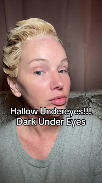 #ad if you have hollow under eyes or areas that have lost fullness I really recommend trying this out! #hollowundereyes #darkcircles #undereyecircles #undereyes #tiktokshopcreatorpicks 