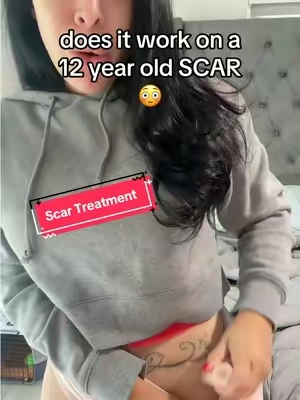 literally buying more before it sells out again for 4 months #scar #scars #scartreatment #scargel #scarcream #dealsforyoudays 
