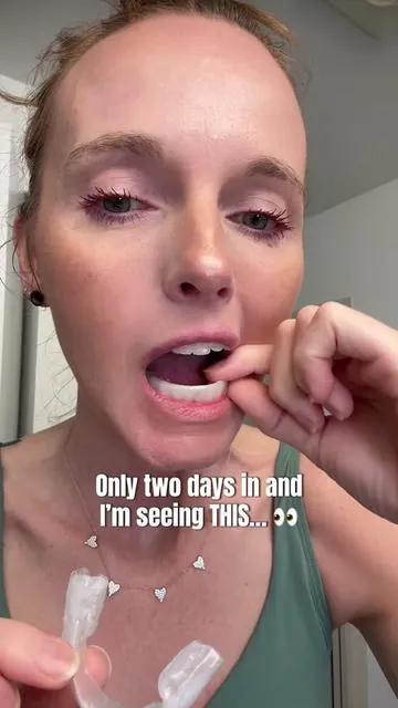 Only 2 days into this teeth whitening kit and I’m already seeing results! 😳 If you’ve been looking for the best teeth whitening kit, a safe way to whiten your teeth at home, or wondering how fast these products actually work — here’s my honest day 2 update.

I’ll keep sharing my teeth whitening progress so you can see if this kit really delivers the results it promises. So far, my smile is already looking brighter after just 48 hours. ✨ ##teethwhitening##teethwhiteningkit##opalescence##teethwhiteningresults##tiktokshopcreatorpicks