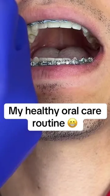 This is how to keep your teeth white and healthy 😁 #braces #bracestips #bracesoff #fyp #viral  