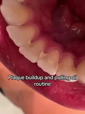 I’m so impressed. #plaque #pullingoil 