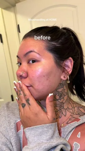 The results shocked me too trust me 😭😂 #microneedling #acnescars #darkspots #hyperpigmentation #skincare 