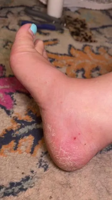 @medicube US Store hypochlorous acid body peel shot is the real deal for getting rid of dead skin! #hypochlorousacidspray #medicubepeelshot #peelshot 