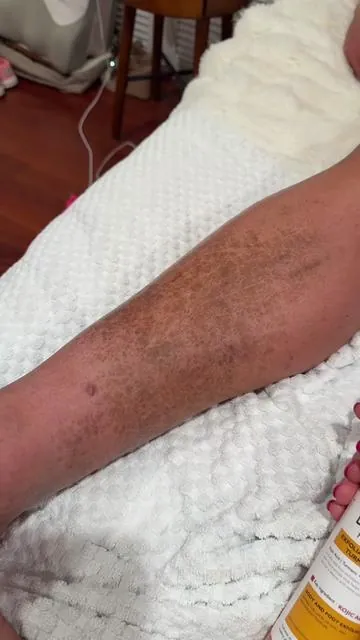 Ok but this Dr Melaxin turmeric peel  spray is ACTUALLY WORKING to remove the dark spots on his legs!! 🤯 Nothing we’ve tried has ever worked this well #tiktokshopblackfriday #turmeric #skin #darkspots #treatment 