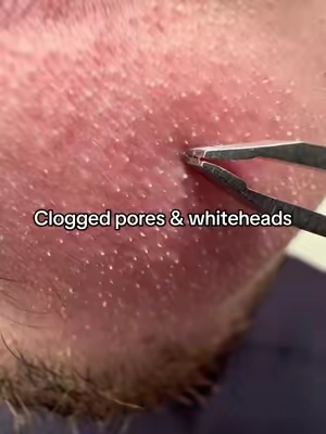 I’m so impressed #peelshot #drmelaxin #cloggedpores #blackhead #koreanskincare 