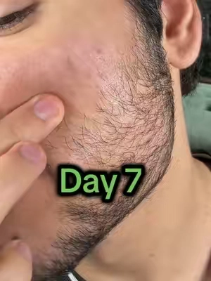 Fixed my biggest insecurity in just a week #hairgrowth 
