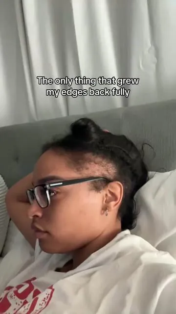 Y’all I’m in shock I was BALD. I have a bad habit of ripping my hair out guys lmaooo it’s psychotic I know but I used to full blown pick my edges out I think that’s called trichotillomania ? I’m in shock omg I was bald. Anyways @Bask and Lather Co is the main product that actually grew it back fast, full, and healthy 🥲 I used it morning and night CONSISTENTLY for months. It’s a lightweight oil too which I loved. And I bought this on my own & still buy it! #fyp 