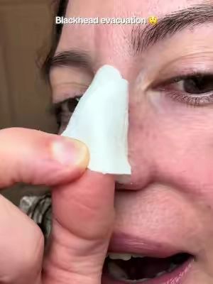 Dr melaxin cactox nose pore strips got all the nasty gunk out of my pores and left my pores looking so clean and small! @Dr.Melaxin Global #drmelaxin #blackhead 
