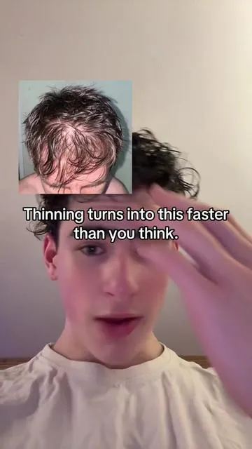 #hims #hairthinning #thinninghair #menshair #tiktokshopcreatorpick 