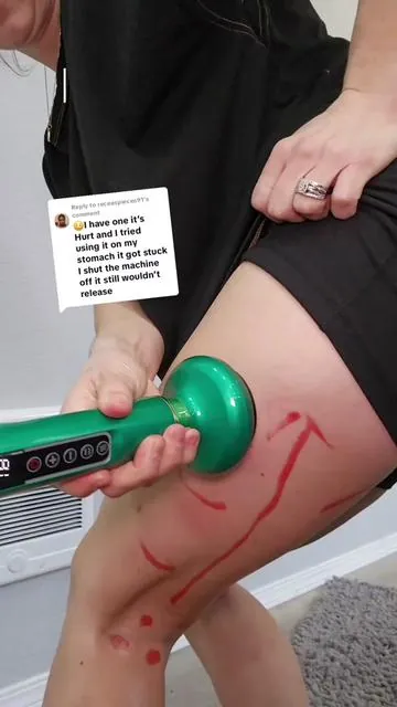 Replying to @receespieces91 what's the saying.. no pain n9 gain? I hope this helps if you wanna try it again. @Wavy Chic Beauty #cuppingtherapy #cellulitereduction #lymphaticdrainage #musclerecovery #foryoupage 