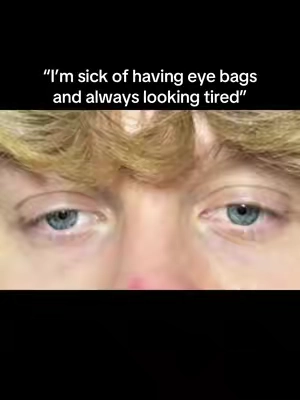 This literally saved me I was sick of looking like a zombie. Results may vary comment any questions you have!#undereyebags 