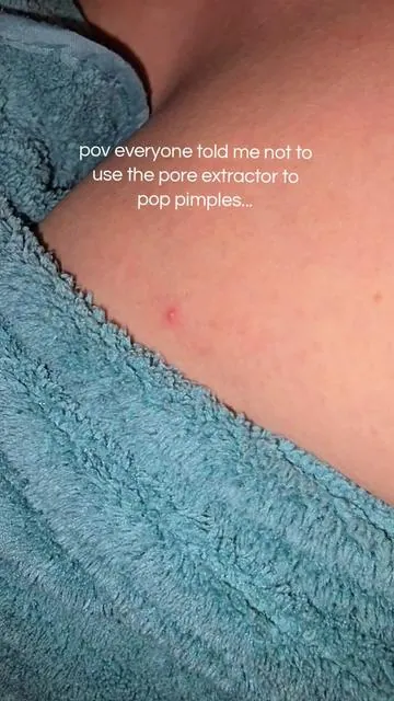 #porecleaner  #poreextraction  #blackheadextractor  #blackheadremovalkit  #poppingpimples 
