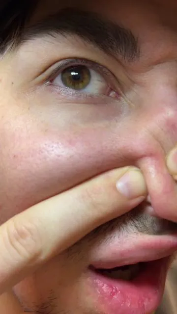 Finally a peel shot that CLOSES your pores #acne #blackhead #peelshot #drmelaxinpeelshot #koreanskincareroutine 