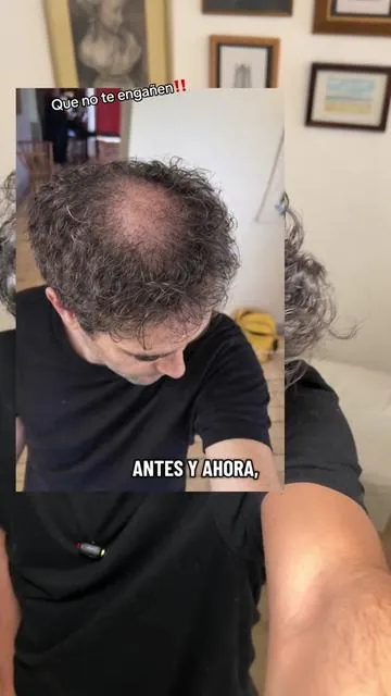 Mi experiencia y reseña ☝🏼#resultsmayvary #minoxidil #caidadecabello el video es solo mi experiencia y no consejo médico. Si tienes dudas de salud consulta a un médico