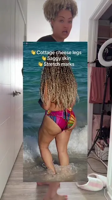 Bye bye cottage cheese legs 👋 

#cellulite #cryothermalgel #saggyskin #stretchmarks #GlowUp 