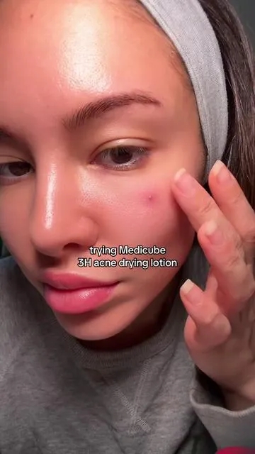 #pimpleremover 