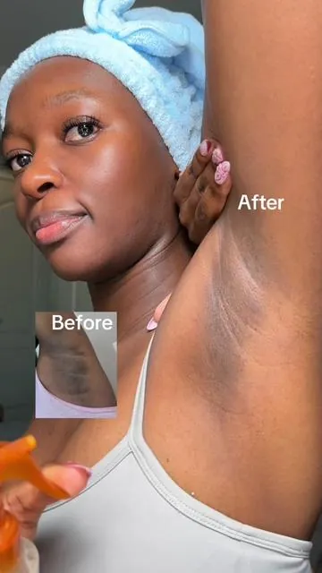 I’ve been using the Dr. Melaxin Peel Shot Exfoliating Kojic & Turmeric Spray and my skin has been looking so much brighter and smoother lately 😭✨ It helps exfoliate, refine texture, and improve the look of dark spots while still keeping the skin glowing 👀💛 That smooth, radiant skin look? yeah… this is giving exactly that #drmelaxink#kojicacidt#turmericskincareg#glowyskine#exfoliatingskincare@DR MELAXIN SKIN  