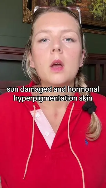 Sun damage in hormonal, hyperpigmentation skin issues… #drmelaxin . . . . This is my experience and results may vary 