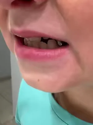 if your kids teeth look like his, it might mean something you’ve been doing isn’t working. it took years and tons of dental procedures and caps before we realized we needed to change something big. and that’s what we did- we switched to nobs jr and nobs tablets and they changed our kids teeth! #nobs #nobsjr #cavities #dental #toothpaste 