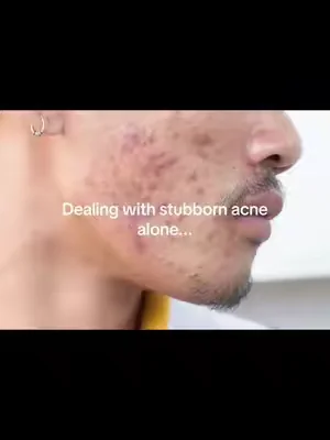 @CLEARSTEM Skincare #tiktokmademebuyit #viral 