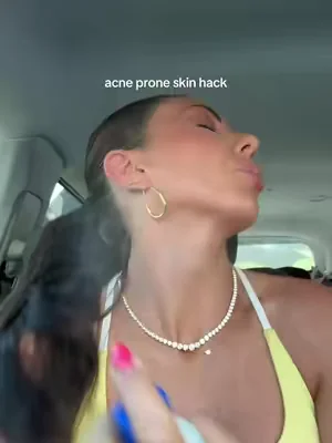 Acne prone skin must have 
