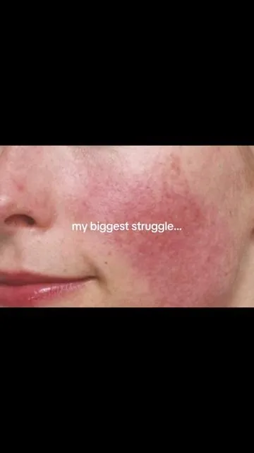 my holy grail for when my skin is reactive/red, also great for rosacea 🥹🙏❤️ prequel redness reform duo redness prone sensitive skin tiktok shop #tiktokshopcreatorpicks #summervibes #DealsForYouDay #tiktokshopdealsforyou #skintok prequel best cleanser serum duo optically reduce redness soothe reactive skin glass skin buy with coupon maehni
