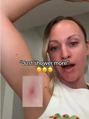 Acne, boils, cysts shouldn’t even exist 🤬

#hydradenitissuppurativa #cysts #acneproneskin #tiktokshopcreatorpicks #boils 