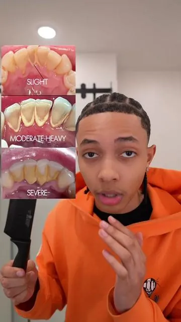 99% of people with plaque don’t know this… 🫢 #plaqueremover #dentalcare #oralhealth #oralhygiene 