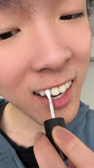 The difference is insane ngl! #teethwhitening #hismile 