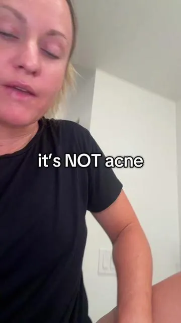 Nothing, I hate more than cysts, boils, and flareups 🤬

#hidradenitissuppurativa #cysts #boils #salicylic #tiktokshopcreatorpicks  