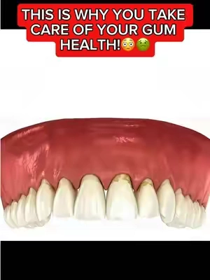 Take care of your gum health!🤢 @GuruNanda LLC #gurunanda #gingivitis #teeth #teethcare 