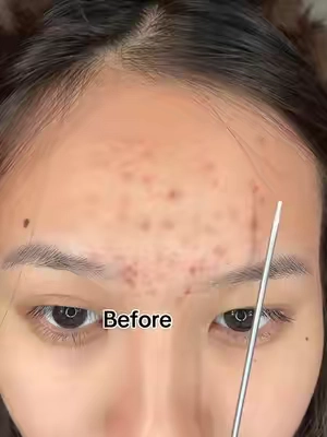 Damaged skin barrier = sudden acne?If you keep breaking out...Don't ignore your skin barrier.Use Dr.Leo CICA Panthenol Jelly Moisturizer.Here is my glow up!💚
#tiktokshopsummersale #skinbarrierrepair #skincare #clearskin #drleohonestreview 