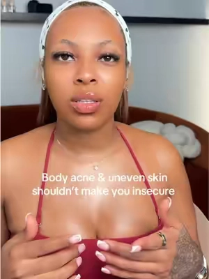 My go to for my blemish prone skin 