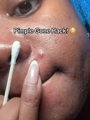 It works so good  #dryinglotion #medicubeskincare #pimple #acneproneskin #zit @medicube global 