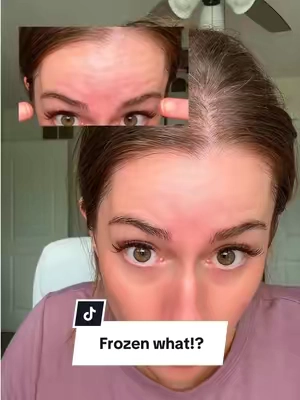 Holy moly! Most skin care is gimmicy but not this one. You have to try this! Forehead lines…umm where?! @SUNGBOON EDITOR  #sungboon #foreheadwrinkles #finelines #egf #koreanskincare 