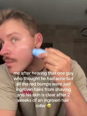 i’m obsessed with this thing  #ingrownhair #shavingbumps #ingrownhairs #bfrelatable #couplegoals      