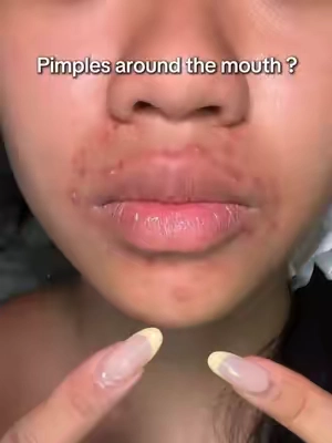 Pimples around the mouth?👄 #tiktokshopstockup #skincare #breakout #acnetreatment #drleodryinglotion 