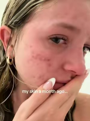 Literally saved my skin… #dralthea #dralthea345cream #acne #ttshop 