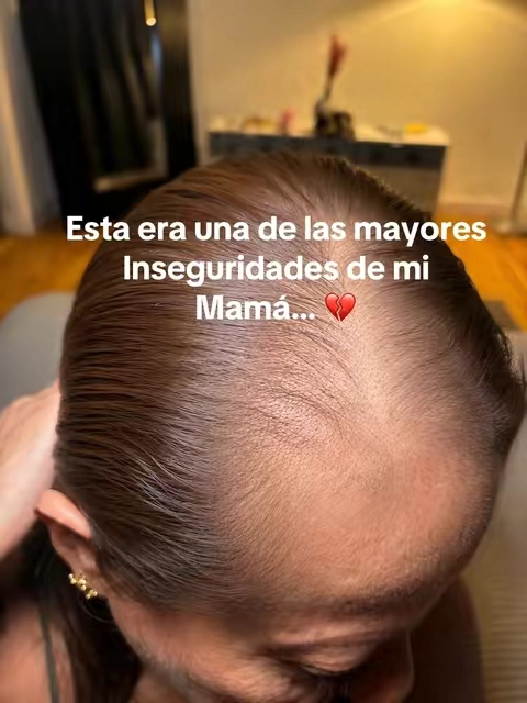 #hairgrowth #caidadecabello #crecimientodelcabello #hairvitamins #cabellolargo 