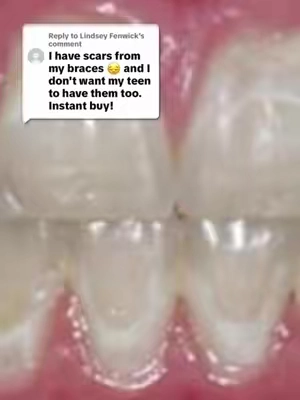 Say NO to tooth scars!!! @Ceelike Oral Care @CEELIKE Global  #braces #scar #prevention #teeth  #viral 