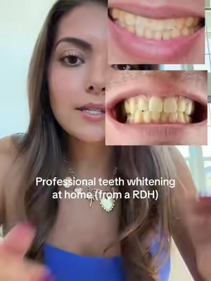As a dental hygienist these are my ALL time FAVORITE teeth whitening for at home!!