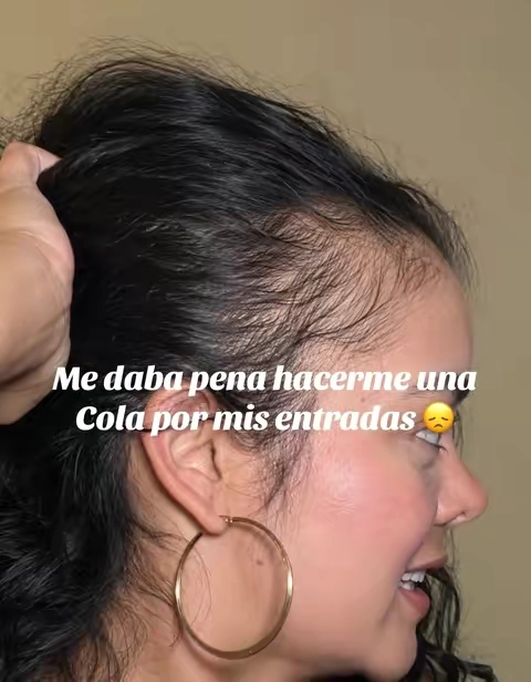 #hairgrowth #caidadecabello #crecimientodelcabello #cabellolargo #hairvitamins 