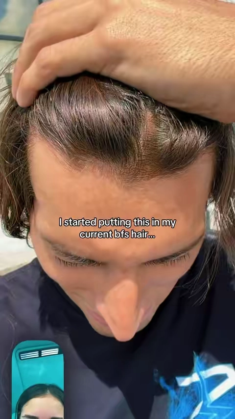 I am not having a bald husband mark my words #hairgrowth #hairline #boyfriend #hairtransformation #balding