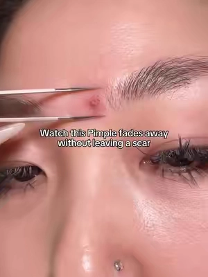 Watch this pimple disappear #acnetreatment #tiktokshopstockup #skincareroutine #pimple #kbeauty 